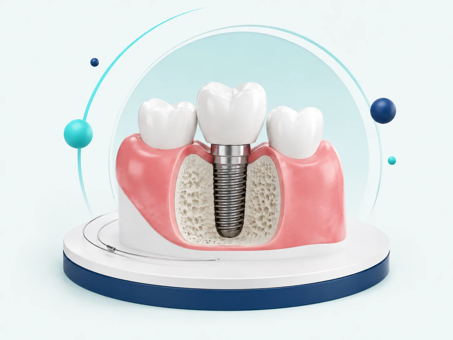 Dental implant model showing an implant-supported replacement tooth